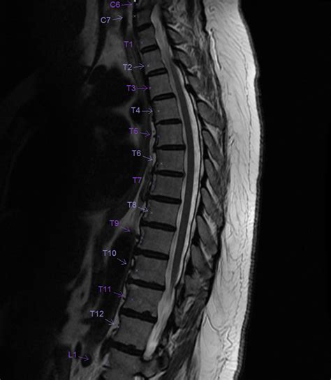 MR THORACIC SPINE - Greater Waterbury Imaging Center