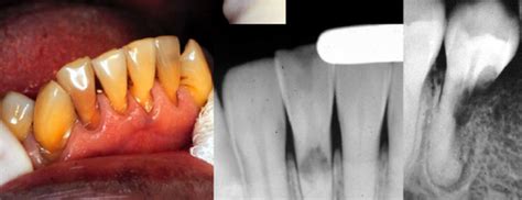 Tooth Discoloration Flashcards | Quizlet