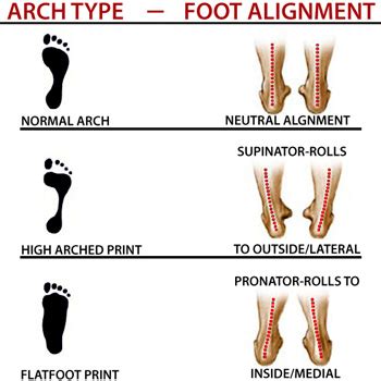 Symptoms and treatment for high and painful arches