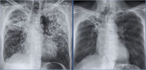 Pulmonary Tb Chest X Ray