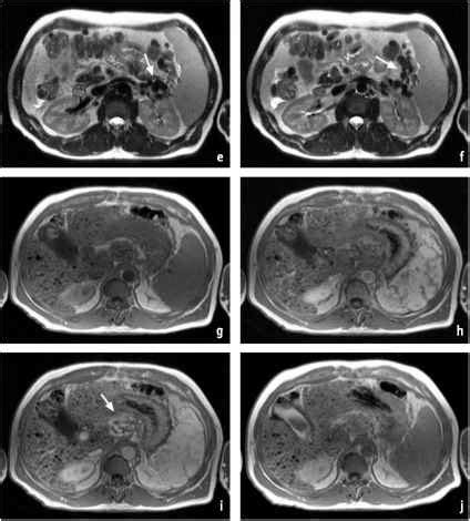 Siderosis - MRI of the Liver - Doctor Steve Abel