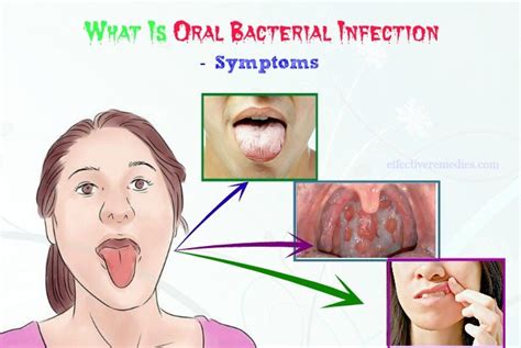 What Is Oral Bacterial Infection? - Causes, Symptoms, Prevention