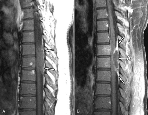 Mri Of A Patient With A Spinal Epidural Abscess Presenting With | My XXX Hot Girl