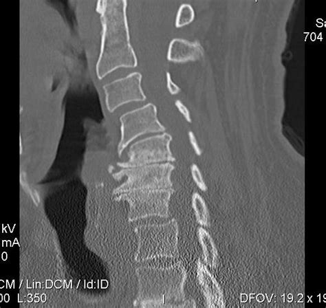 Cervical Spondylosis | The Bone School