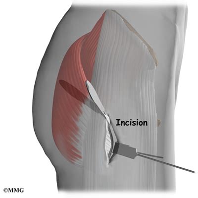 Trochanteric Bursitis Surgery - eOrthopod.com