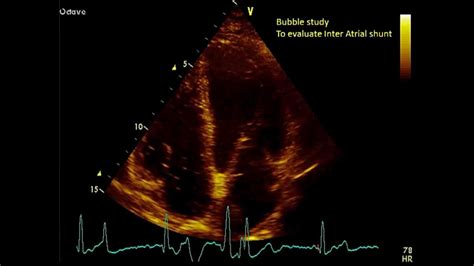 Apical views - Transthoracic Echocardiogram (TTE) - YouTube