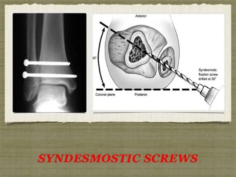 Syndesmotic screw