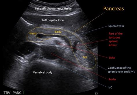 Splenic Vein Ultrasound