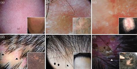 0Dermoscopy of discoid lupus erythematosus of the scalp varies ...