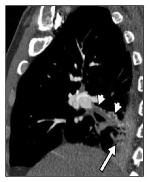 (a) Coronal CTA image in lung window shows infiltrate in the right lung... | Download Scientific ...