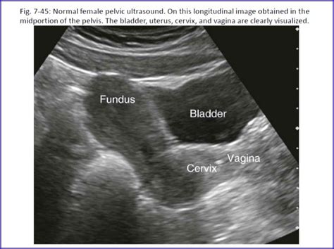 Ultrasound Of Pelvis Female