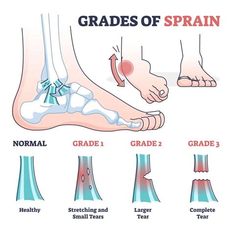 A Sprained Ankle - Causes, Symptoms, Types, Grades, Treatments