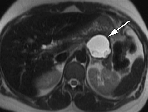 MR Imaging of Cystic Lesions of the Pancreas | RadioGraphics