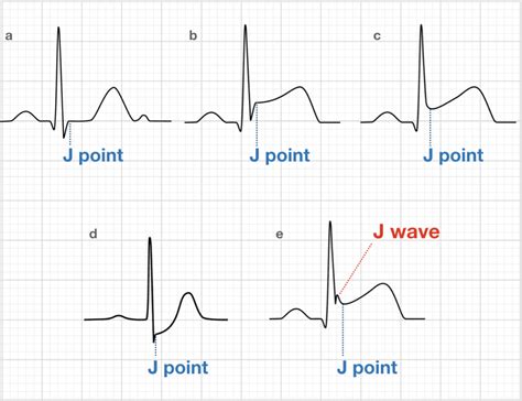 Osborn Wave (J Wave) • LITFL • ECG Library Basics