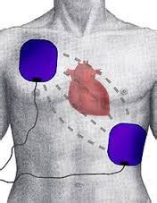 Where to place Defib pads - Defibshop