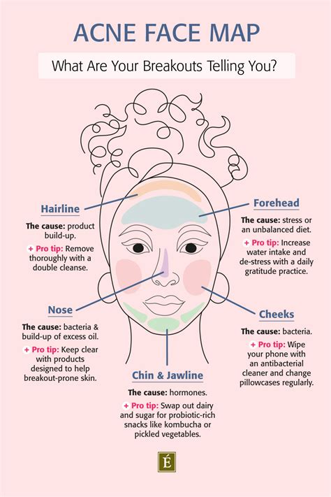 Pimples Face Map: What Are Your Breakouts Telling You? - Doctor Woao