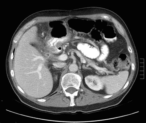 Unresectable Pancreatic Adenocarcinoma: Eight Years Later | Smiley | World Journal of Oncology
