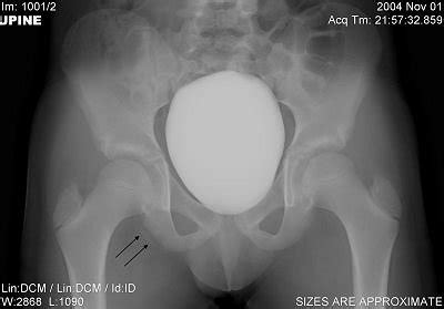 Case study: Acute avulsion fracture of ischial tuberosity in adolescent soccer player