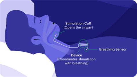 Inspire For Sleep Apnea - What Is It & How It Works