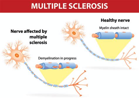 Get to know multiple sclerosis –a neurological disease affecting the brain and spinal cord ...