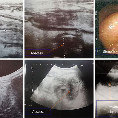 Endoscopy of the terminal ileum. (a) The black arrows show multiple ...