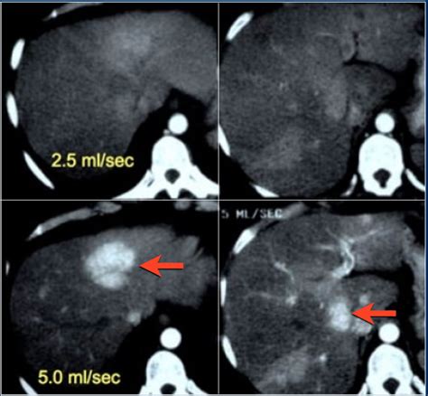 The Radiology Assistant : CT contrast injection and protocols