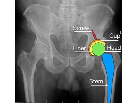 Direct Anterior Hip Arthroplasty Rodriguez Hip And Knee - Riset