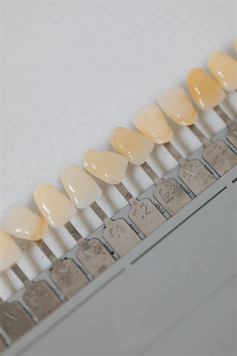 Common types of dental veneers | FindGlob