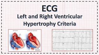 Left and Right Ventricular Hypertrophy ECG criteria | L... | Doovi