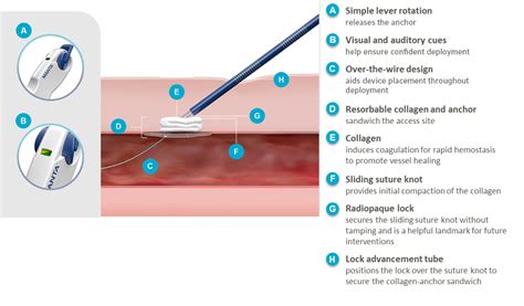 MANTA Vascular Closure Device | EMEA | Teleflex