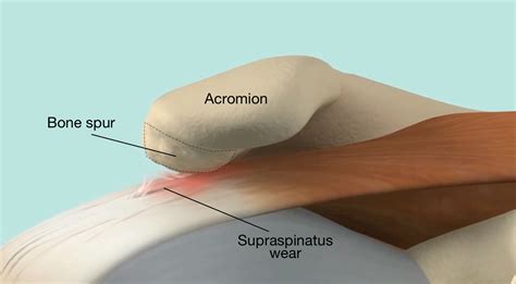 bone-spurs-on-the-undersurface-of-the-acromion-may-create-impingement ...