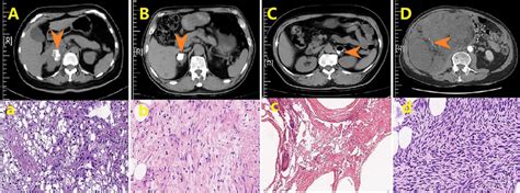 (A) CT of adrenal cortical carcinoma: scattered calcification inside... | Download Scientific ...