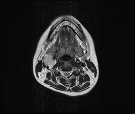 Carotid body tumor MRI - wikidoc