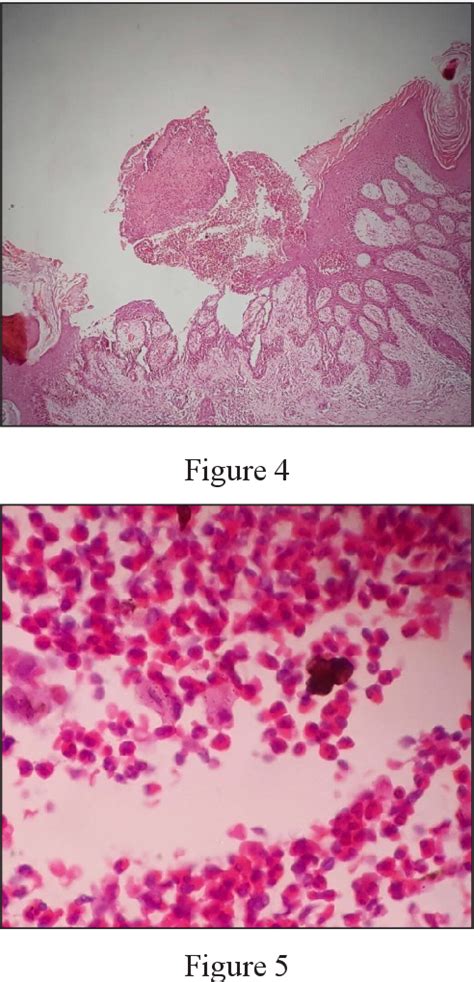 Figure 4 from A Case Report on Pyodermatitis-pyostomatitis vegetans (PD-PSV) in a patient with ...