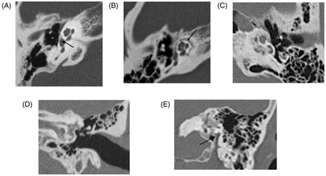 Radiological classifications of otosclerosis on preoperative CT‐scan ...