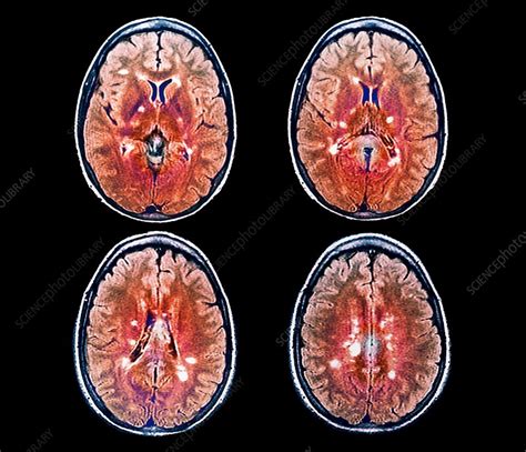 Multiple sclerosis, MRI scans - Stock Image - C047/4268 - Science Photo ...