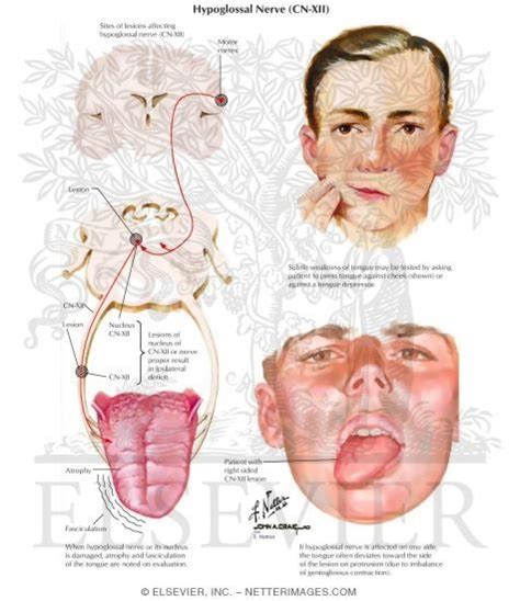 Throat pain glossopharyngeal neuralgia – Artofit