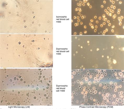 Figure 1 from DIFFERENTIATION OF GLOMERULAR FROM NON- GLOMERULAR ...