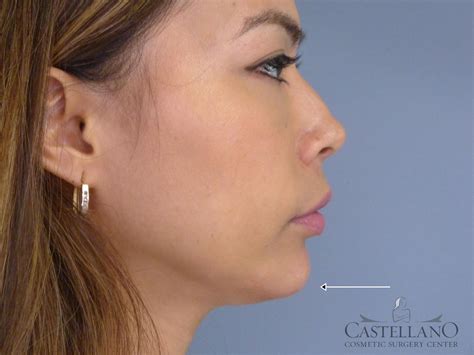 9281 Injectable Fillers | Castellano Cosmetic Surgery Center.