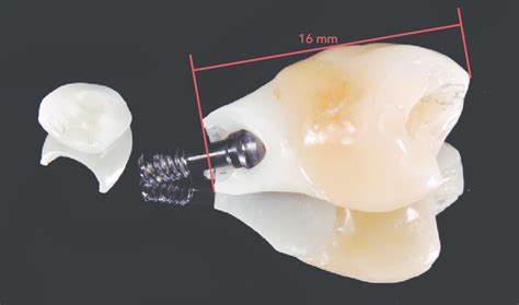 Fractured zirconia abutment with external connection regular platform... | Download Scientific ...