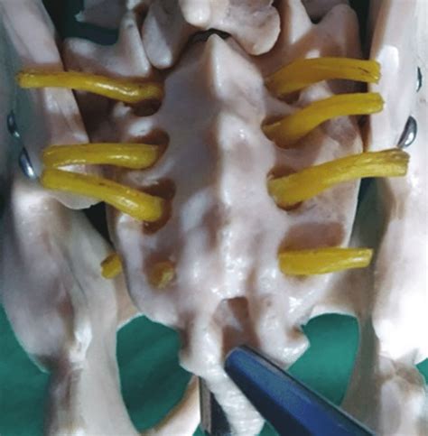 Sacral hiatus Fig. 2: Lateral view pointing sacral hiatus | Download ...