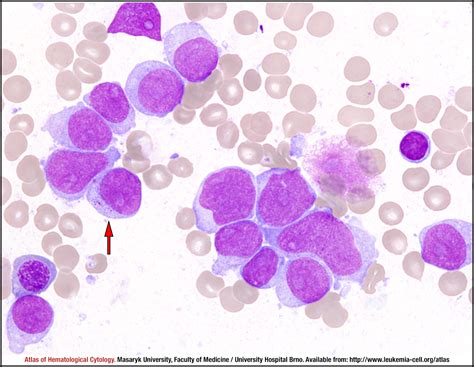 Acute Myelomonocytic Leukemia