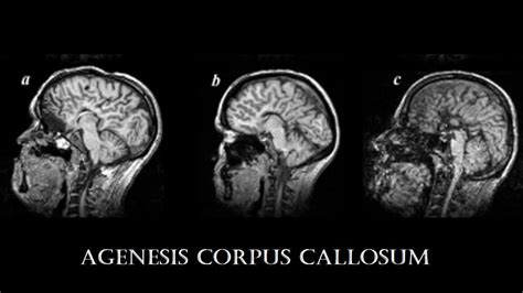 Agenesis Corpus Callosum: Definition, 4 Types, Causes, Risk Factors, Pathogenesis, Etiology ...