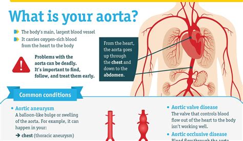 Infographic: Conditions That Cause Aortic Disease | Doctors Without ...