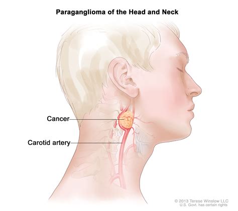 Throat Cancer Lump On Outside Of Neck