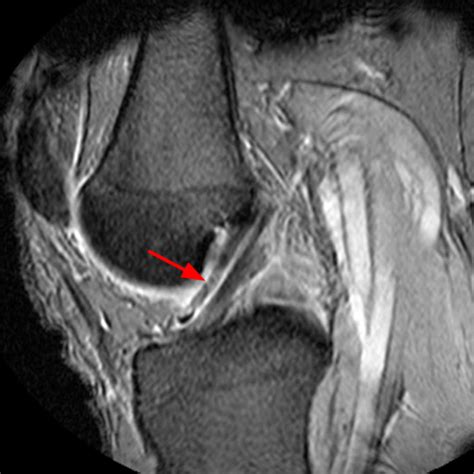 Synovial Plicae of the Knee | Radsource