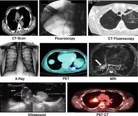 Chapter 2 Review on Image Guided Lung Biopsy | Semantic Scholar