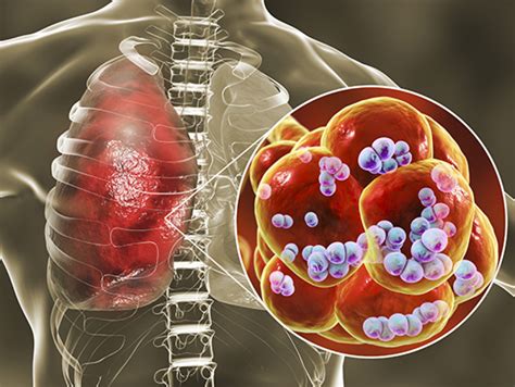 An atlas of S. pneumoniae and host gene expression during colonization and disease - News | UAB