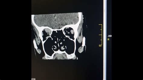 Tumefactive inflammatory pseudotumor of orbit /IgG4 related orbital disease. - YouTube