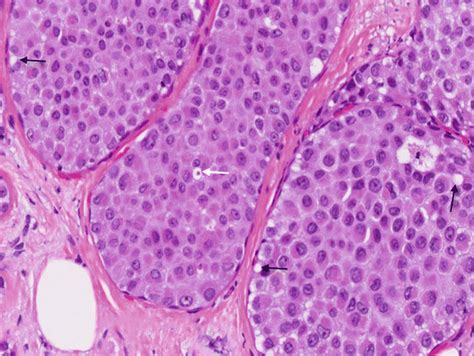 Lobular Lesions (Lobular Neoplasia, Invasive Lobular Carcinoma) | Basicmedical Key